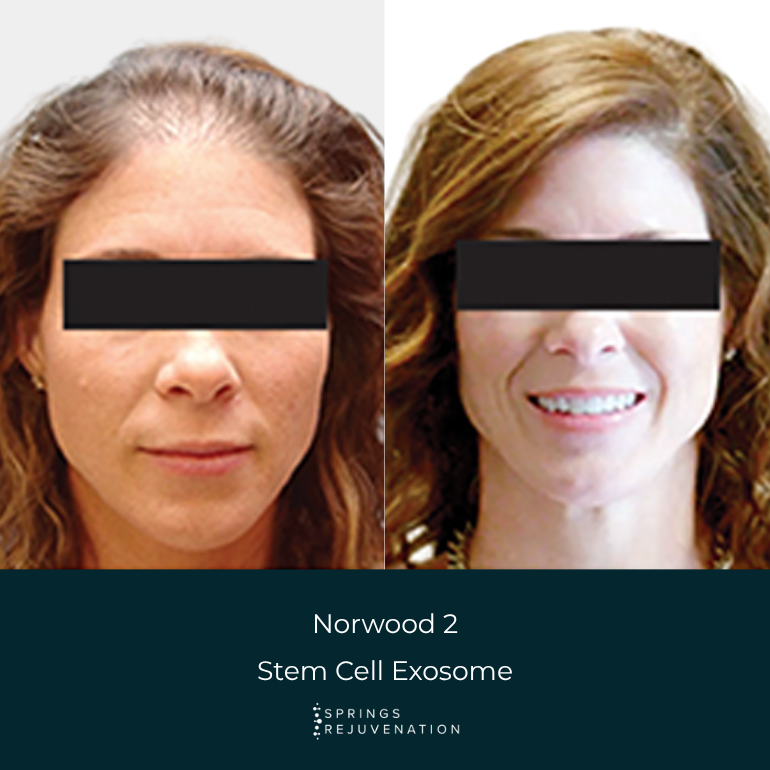 Norwood 2 Stem Cell Exosome